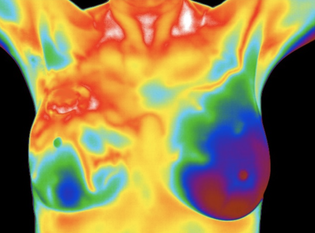 Thermography breast